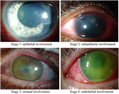 Topical Corticosteroids In Acanthamoeba Keratitis Friend Or Foe Karlijn A Wouters Jennifer