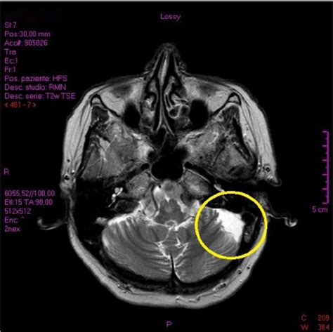 Posterior Fossa Arachnoid Cyst MRI