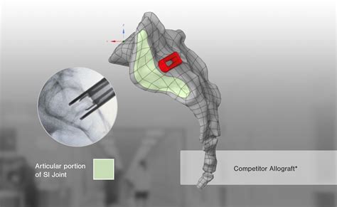 Ifuse Intra X® Si Bone