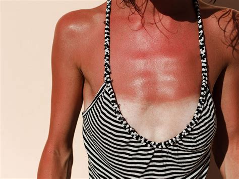 The Best Sunburn Treatment Thethirty