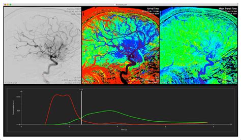 Digital Subtraction Angiography Dsa Data Encodes The Temporal Passage