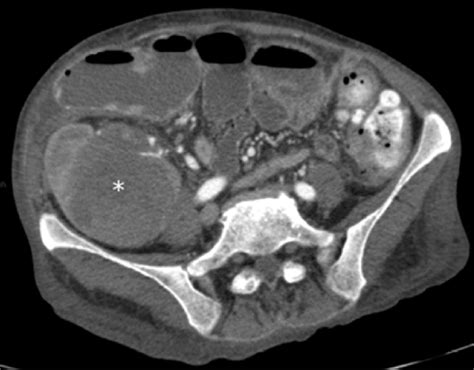 Contrast Enhanced Axial Ct Of The Abdomen In The Arterial Phase