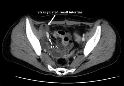 Enhanced Ct Scan Image Shows The Strangulated Small Intestine