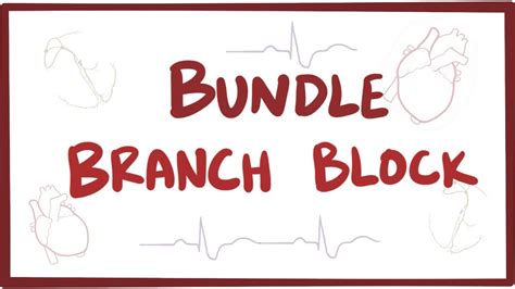 Bundle branch block: Video, Causes, & Meaning | Osmosis