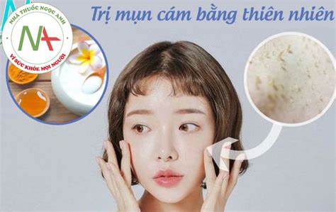 Top 6 Cách Trị Mụn Cám Bằng Thiên Nhiên đơn Giản Và Hiệu Quả Tại Nhà