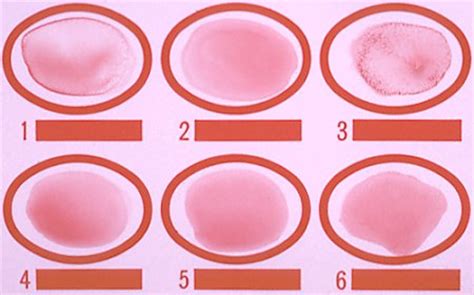 Plasma Fdp Assay Eclinpath