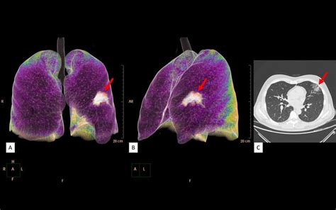 A B Chest Volume Rendering Tomography C Chest Computed