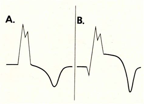 Figure 2 From Variant Prinzmetal S Form Of Angina Pectoris