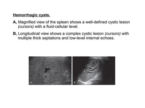 Spleen Ultrasound anatomy structure scanning techniques and pathologies