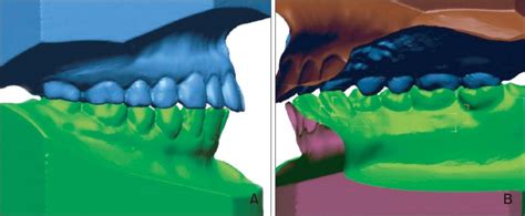 Differences In Molar Relationships And Occlusal Contact Areas Evaluated From The Buccal And