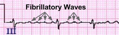 Atrial Fibrillation ECG Review Learn The Heart