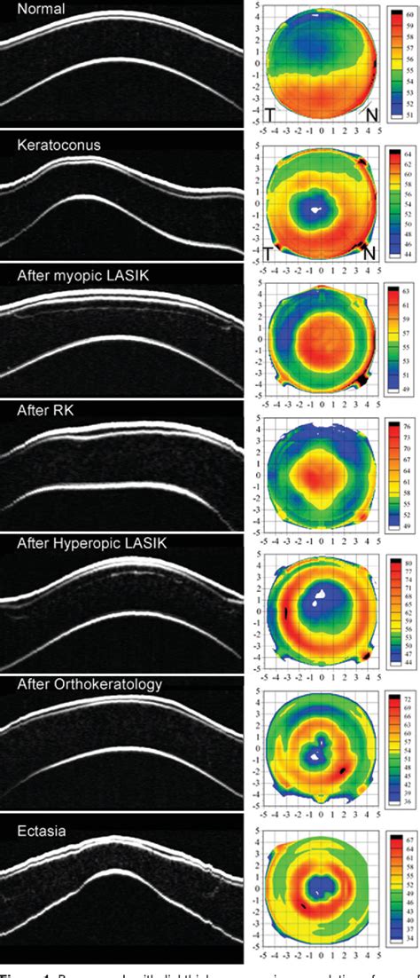 Figure 1 From Applications Of Epithelial Thickness Mapping In Corneal