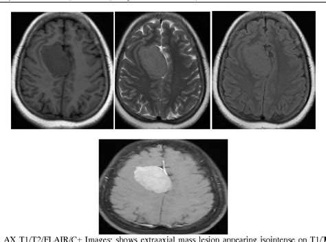 Figure 3 From Imaging Of Intracranial Space Occupying Lesions A