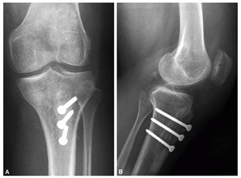 Overmedialization Following Tibial Tuberosity Osteotomy ...