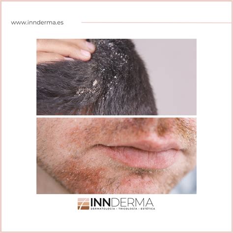 Dermatitis Seborreica Causas Y Tratamiento Innderma