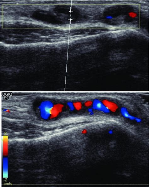 Temporal Artery Ultrasound