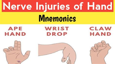 Ape Hand,Wrist Drop,Claw Hand |Radial,ulnar,median nerve injuries - YouTube