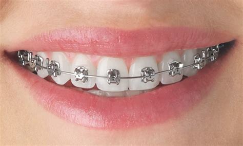 Orthodontic Treatment Southern Smiles Orthodontics