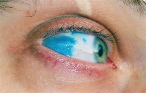 Blue Sclera Medical Pictures Blue Photo