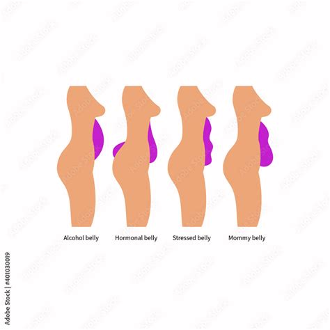 Different types and causes of abdominal obesity in women Stock Vector ...