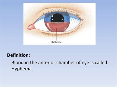 Hyphema | PPT