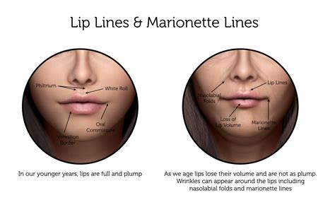 Lip Lines And Marionette Lines In London Rejuvence Clinic