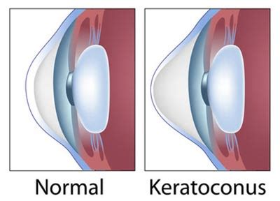 Keratoconus Treatment · Top Eye Doctor Specialist · Ophthalmologist NYC