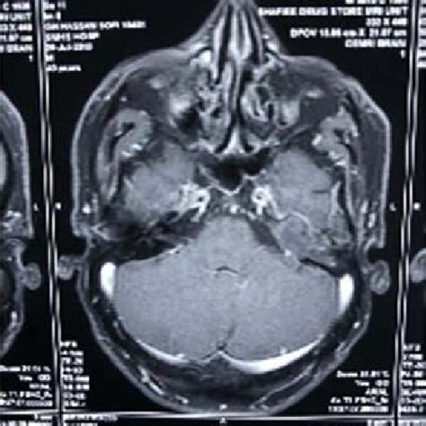 Contrast Enhanced MRI. | Download Scientific Diagram