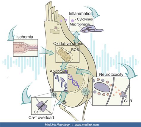 Noise Induced Hearing Loss Medlink Neurology