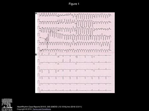 Wide Complex Tachycardia In An Elderly Woman Due To Ebsteins Anomaly