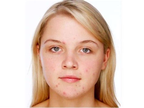 Smoothen Face Skin Remove Pimples And Blemishes In Photoshop Healing