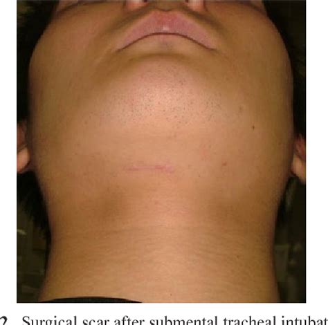 Figure 1 From Efficacy And Complications Of Submental Tracheal