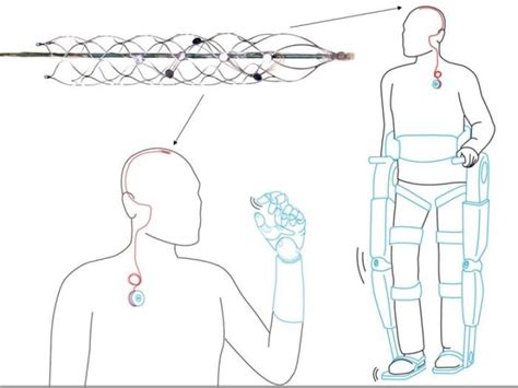 Implant Could Bring Wireless Exoskeleton Control To Paralyzed People