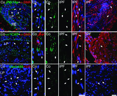 Expression Of Peroxisomal Proteins In Human Lung Biopsies Of Control