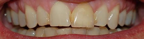 Internal Tooth Bleaching Rockville, MD | Root Canal Dentist