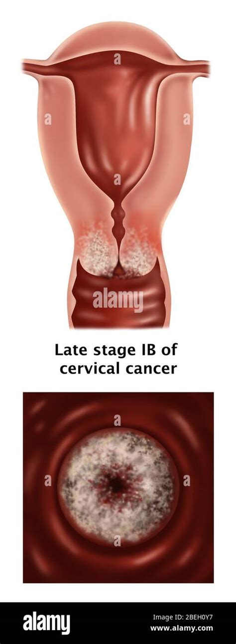 Late Stage Cancer Hi Res Stock Photography And Images Alamy