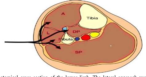 Figure 1 from Comparison of Fasciotomy Wound Closures Using Single ...