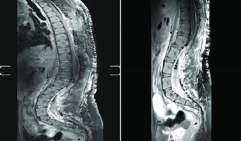 Postoperative Mri Demonstrating Complete Resection Of The Five