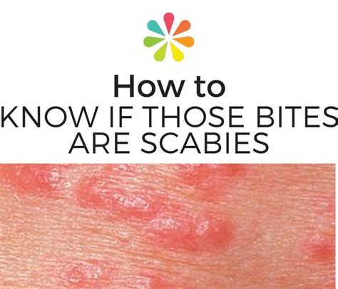 Scabies Rash Treatment Wedding Ideas You Have Never Seen Before