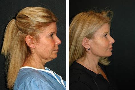 Deep Plane Facelift Deep Plane Facelifting Dr Andrew Jacono