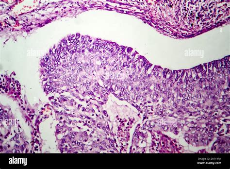 Lung Adenocarcinoma Light Micrograph Photo Under Microscope Stock