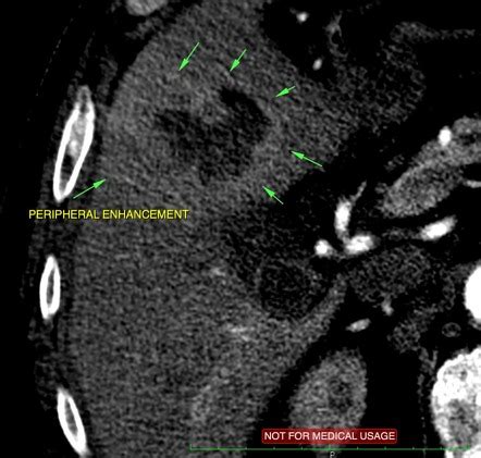 Hepatic Abscess Related To Acute Cholecystitis Image Radiopaedia Org