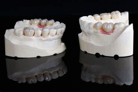 Denture Over Implant Bars | Tanaka Digital Lab