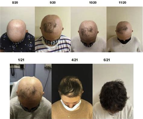 Photographs of frontal scalp and vertex over 10 months. | Download ...