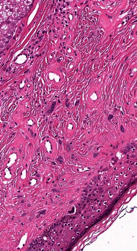 Pathology Of Fibrous Papule Of The Nose