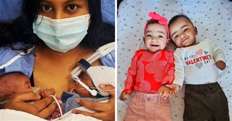 Most Premature Twins Ever Born At 22 Weeks Doing Great One Year Later