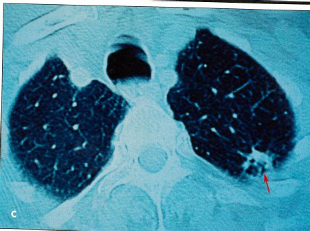 Cavitary Lung Cancer With Metastases | Consultant360