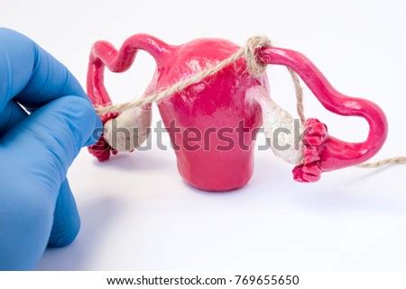 TUBECTOMY Stock Photos and Images - Avopix.com