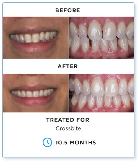 SureSmile before and after: See the difference! | SureSmile