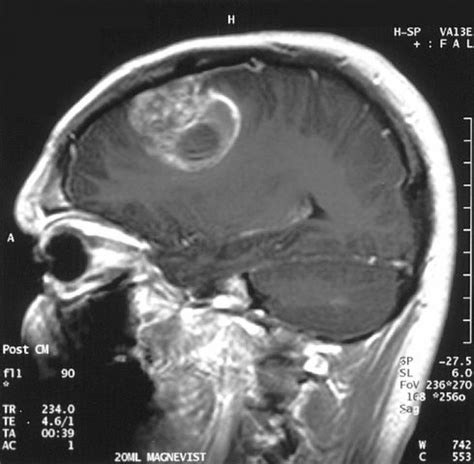 Glioblastoma Multiforme Concise Medical Knowledge